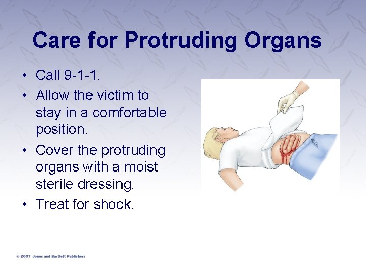 Care for Protruding Organs • Call 9 -1 -1. • Allow the victim to