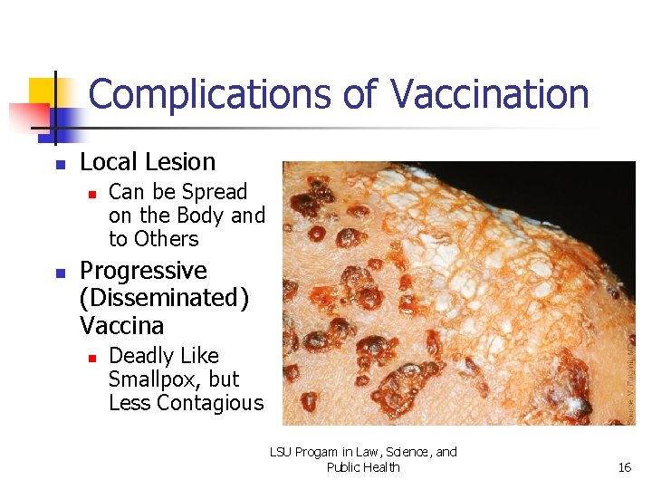 Complications of Vaccination n Local Lesion n n Can be Spread on the Body