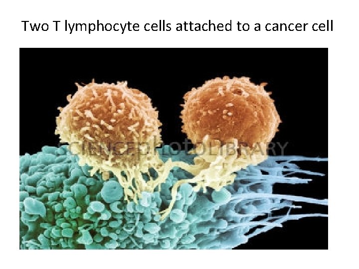 Two T lymphocyte cells attached to a cancer cell 
