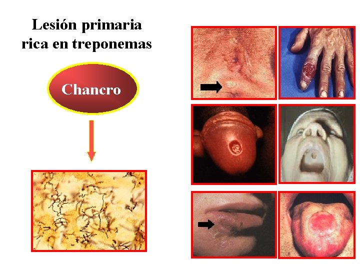 Lesión primaria rica en treponemas Chancro 