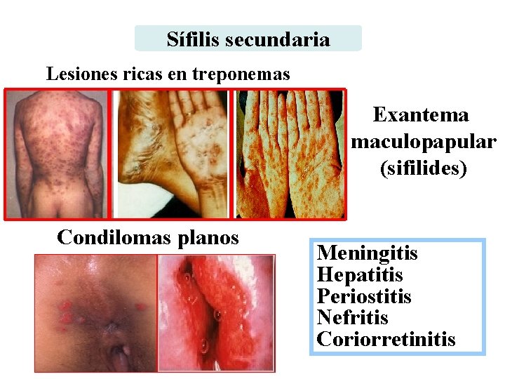 Sífilis secundaria Lesiones ricas en treponemas Exantema maculopapular (sifilides) Condilomas planos Meningitis Hepatitis Periostitis