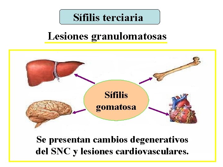 Sífilis terciaria Lesiones granulomatosas Sífilis gomatosa Se presentan cambios degenerativos del SNC y lesiones