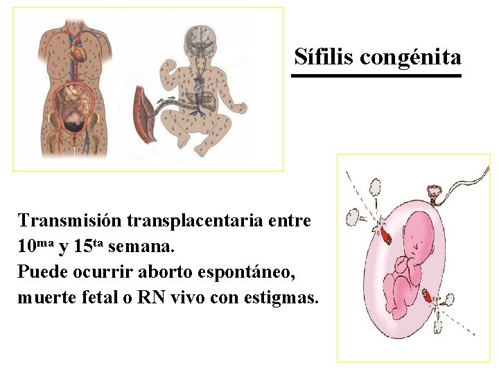 Sífilis congénita Transmisión transplacentaria entre 10 ma y 15 ta semana. Puede ocurrir aborto