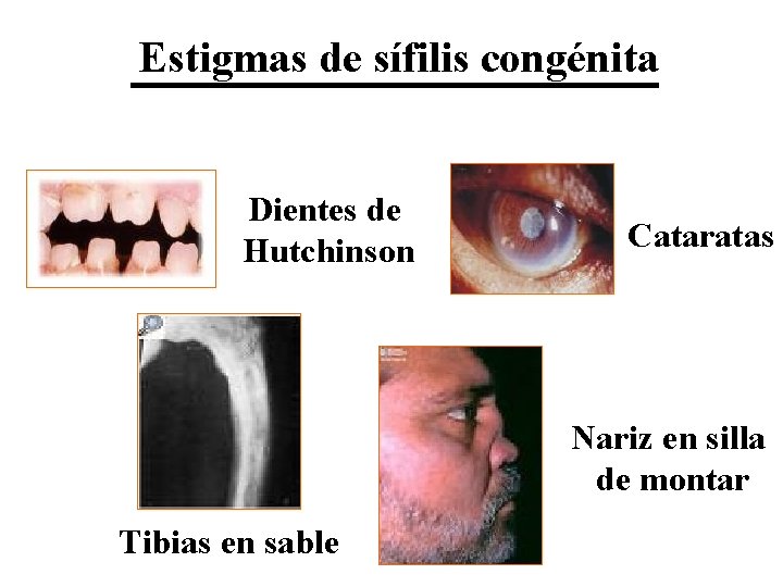 Estigmas de sífilis congénita Dientes de Hutchinson Cataratas Nariz en silla de montar Tibias