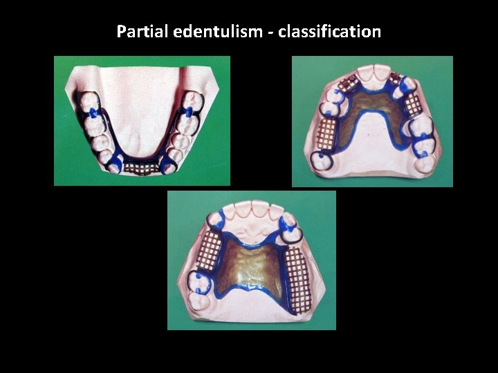 Partial edentulism - classification 