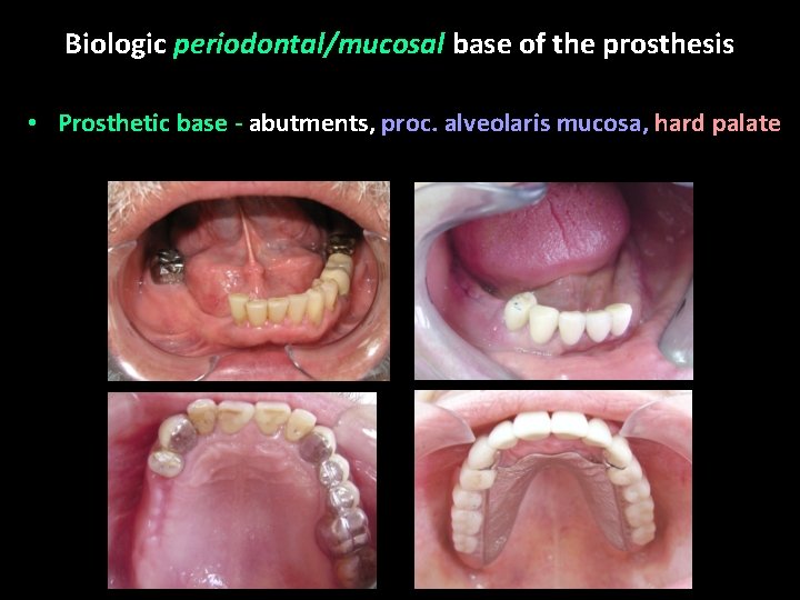 Biologic periodontal/mucosal base of the prosthesis • Prosthetic base - abutments, proc. alveolaris mucosa,