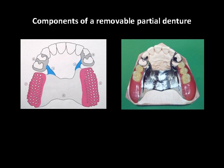 Components of a removable partial denture 