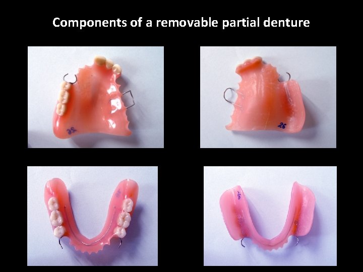 Components of a removable partial denture 