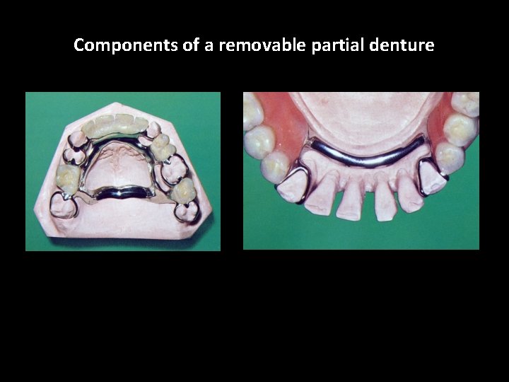 Components of a removable partial denture 