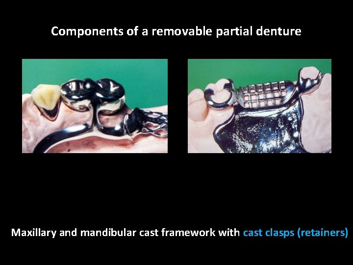 Components of a removable partial denture Maxillary and mandibular cast framework with cast clasps