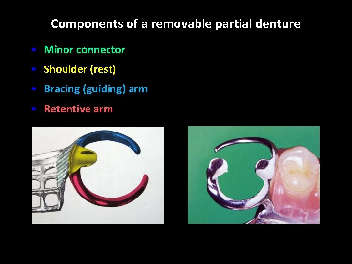 Components of a removable partial denture • Minor connector • Shoulder (rest) • Bracing