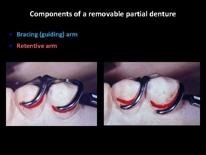 Components of a removable partial denture • Bracing (guiding) arm • Retentive arm 