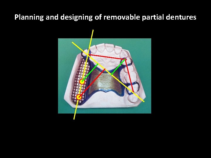 Planning and designing of removable partial dentures 