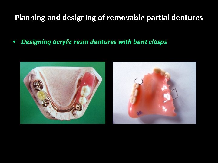 Planning and designing of removable partial dentures • Designing acrylic resin dentures with bent