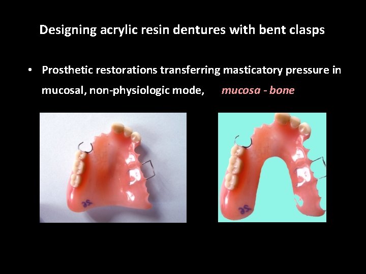 Designing acrylic resin dentures with bent clasps • Prosthetic restorations transferring masticatory pressure in