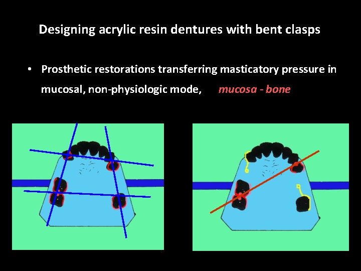 Designing acrylic resin dentures with bent clasps • Prosthetic restorations transferring masticatory pressure in