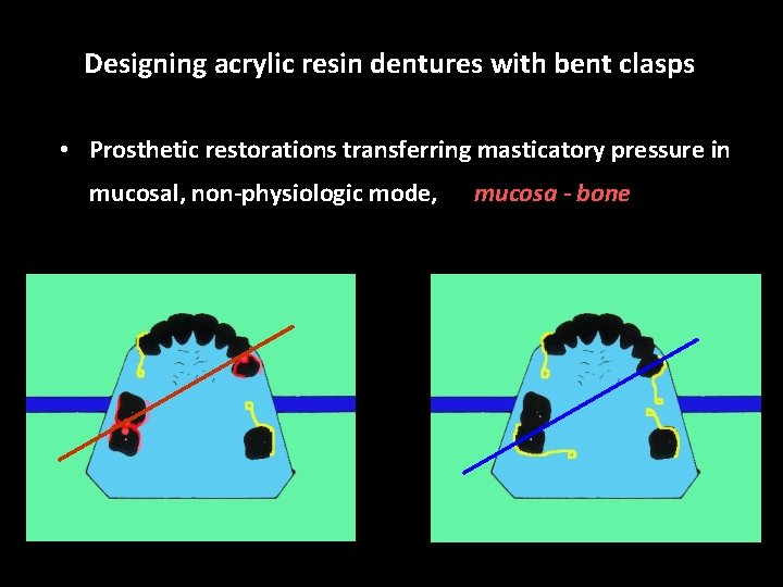 Designing acrylic resin dentures with bent clasps • Prosthetic restorations transferring masticatory pressure in
