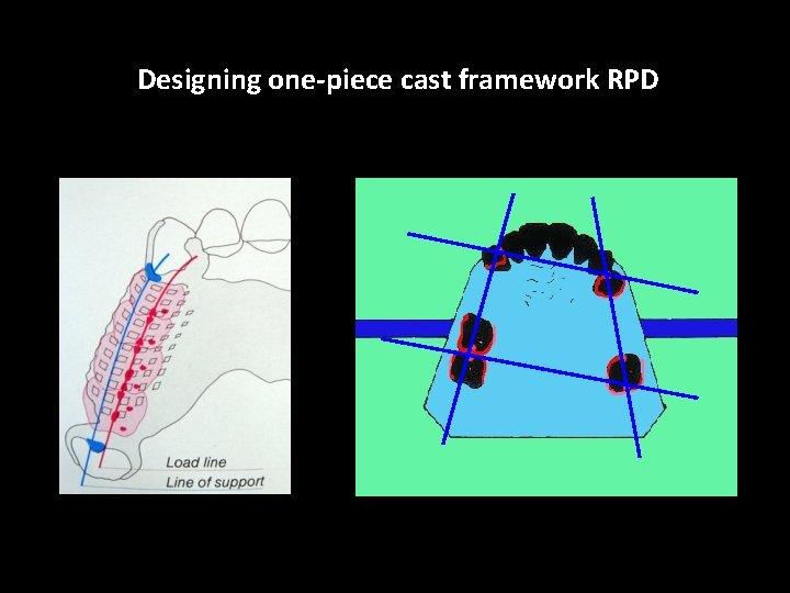 Designing one-piece cast framework RPD 