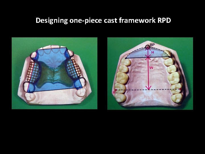 Designing one-piece cast framework RPD 