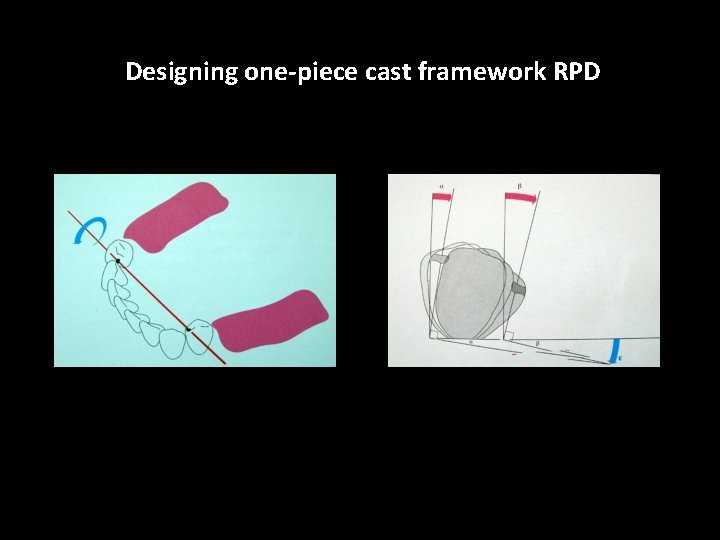 Designing one-piece cast framework RPD 