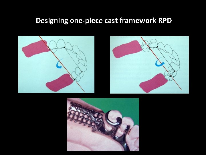 Designing one-piece cast framework RPD 