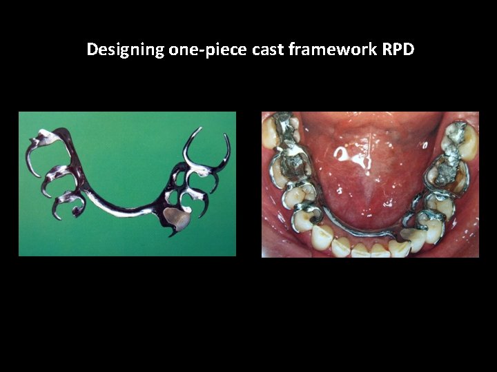 Designing one-piece cast framework RPD 