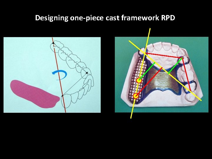 Designing one-piece cast framework RPD 