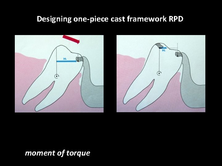 Designing one-piece cast framework RPD moment of torque 