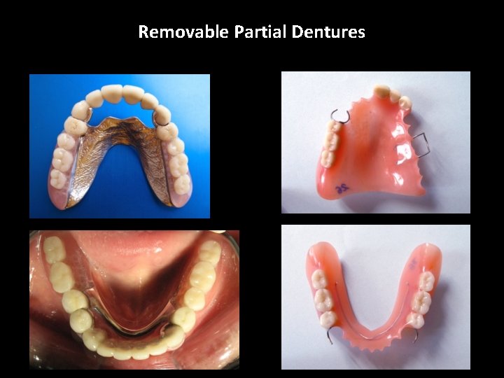 Removable Partial Dentures 