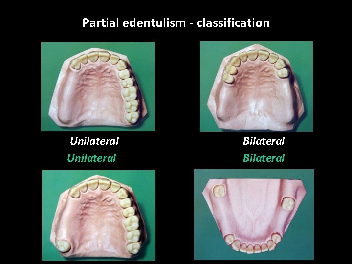 Partial edentulism - classification Unilateral Bilateral 