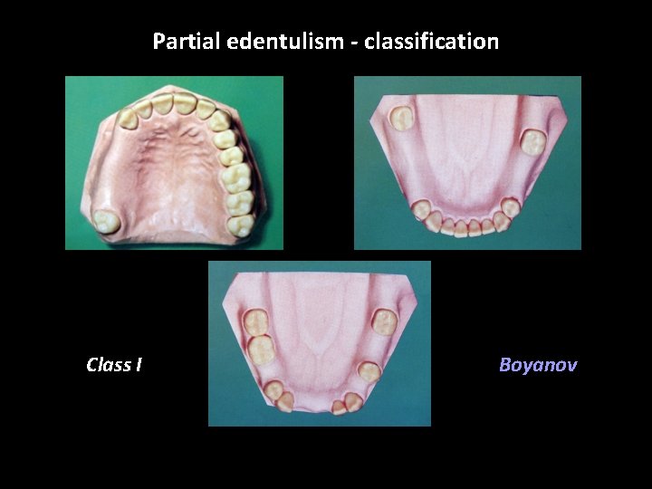 Partial edentulism - classification Class I Boyanov 