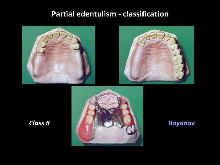 Partial edentulism - classification Class II Boyanov 