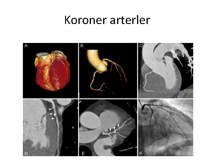 Koroner arterler 