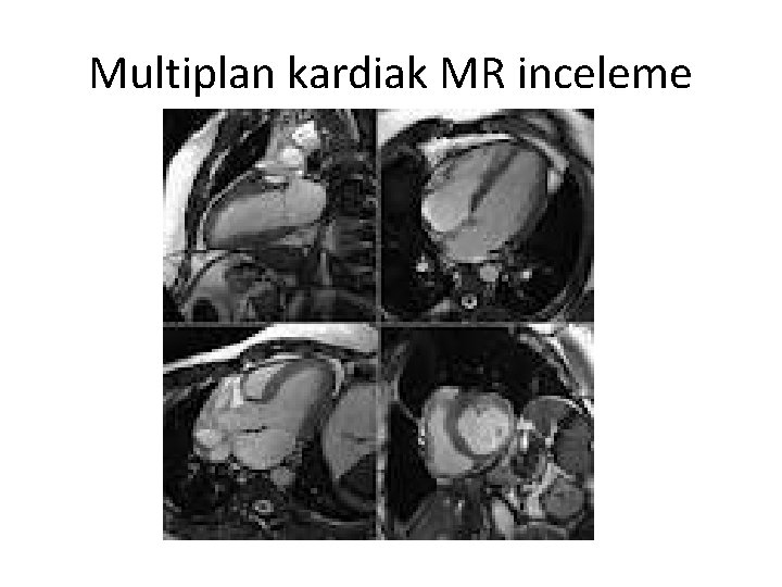 Multiplan kardiak MR inceleme 