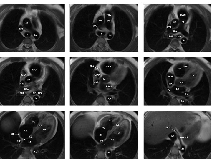 Kardiak incelemede MR kesitleri 