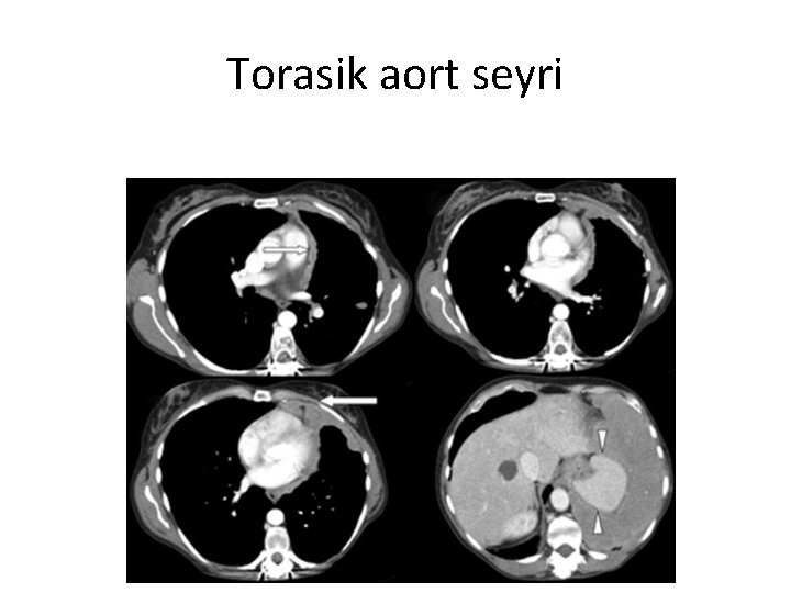Torasik aort seyri 