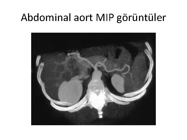 Abdominal aort MIP görüntüler 