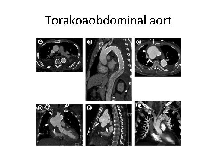 Torakoaobdominal aort 