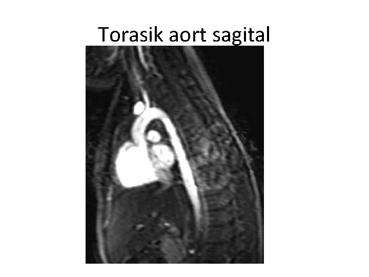 Torasik aort sagital 