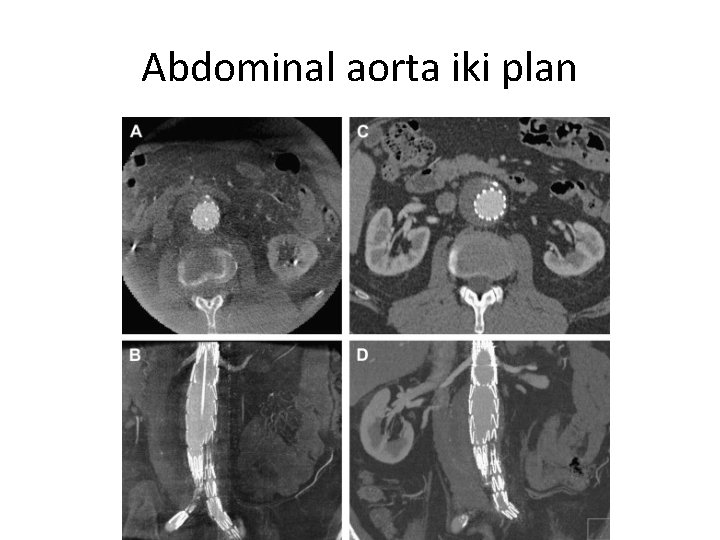 Abdominal aorta iki plan 