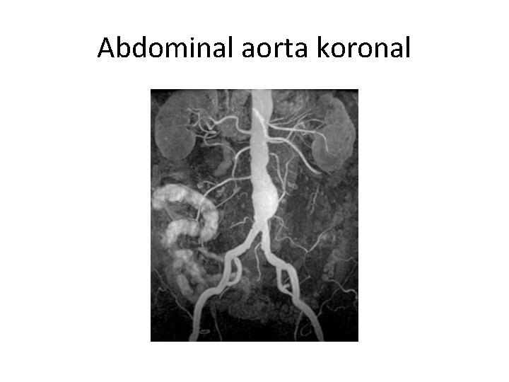 Abdominal aorta koronal 