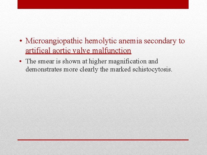  • Microangiopathic hemolytic anemia secondary to artifical aortic valve malfunction • The smear