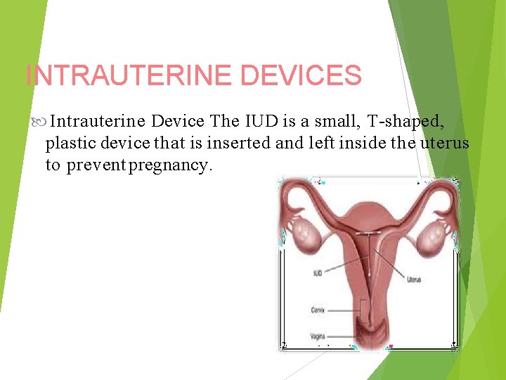 INTRAUTERINE DEVICES Intrauterine Device The IUD is a small, T-shaped, plastic device that is