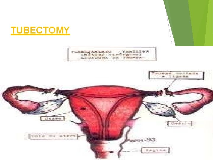 TUBECTOMY 