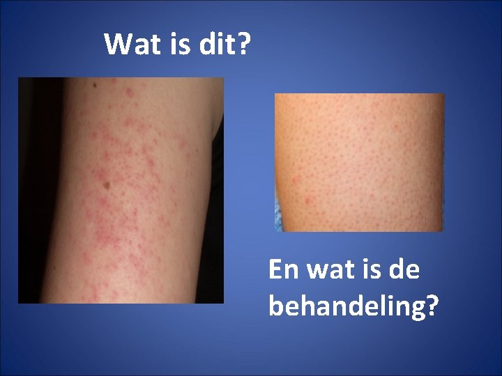 Wat is dit? En wat is de behandeling? 