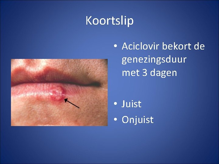 Koortslip • Aciclovir bekort de genezingsduur met 3 dagen • Juist • Onjuist 