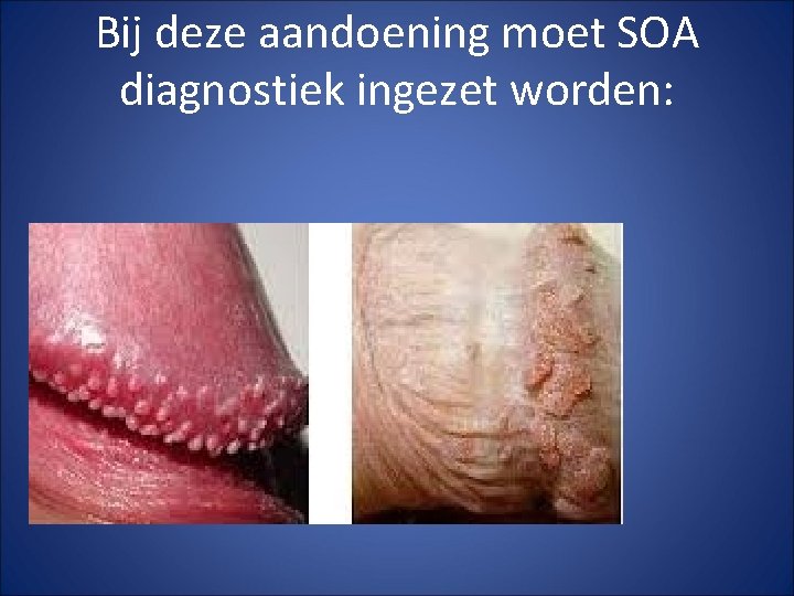 Bij deze aandoening moet SOA diagnostiek ingezet worden: 