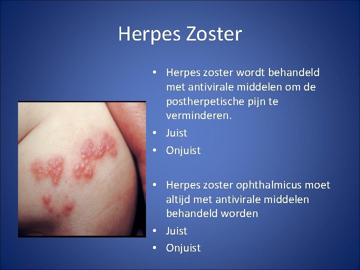 Herpes Zoster • Herpes zoster wordt behandeld met antivirale middelen om de postherpetische pijn