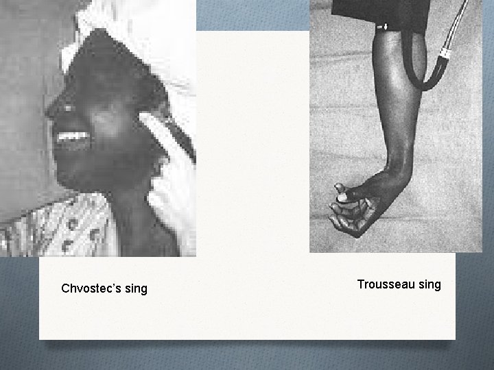 Chvostec’s sing Trousseau sing 