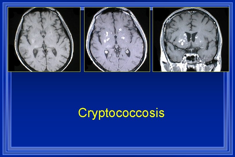 Cryptococcosis 